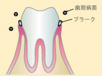 歯周病の進行