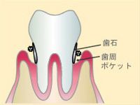 歯周病の進行