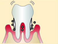 歯周病の進行